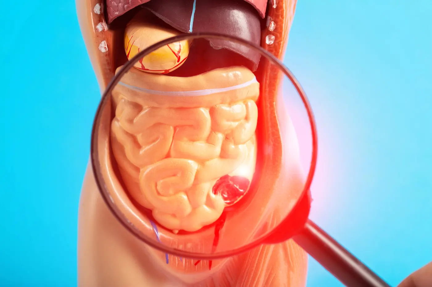 Especialista en diverticulitis y sigmoidectomía laparoscópica en Zapopan