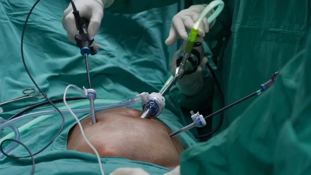Procedimiento — Especialista en diverticulitis y sigmoidectomía laparoscópica en Zapopan
